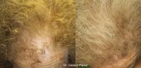 Tratamiento alopecia